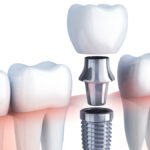 İmplant Tedavisi Nedir?